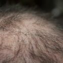 hair loss 2
