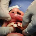 dental implant
